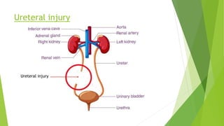 Ureteral injury
Ureteral injury
 