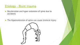 Etiology - Blunt trauma
 Deceleration and hyper extension of spine due to
accidents
 The Hyperextension of spine can cause Ureteral injury
 