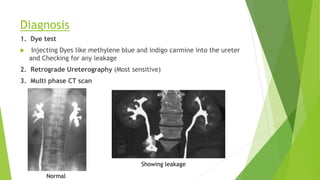 Diagnosis
1. Dye test
 Injecting Dyes like methylene blue and indigo carmine into the ureter
and Checking for any leakage
2. Retrograde Ureterography (Most sensitive)
3. Multi phase CT scan
Normal
Showing leakage
 