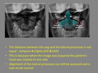 • The distance between the peg and the lateral processes is not
equal - compare A (right) with B (left)
• This is because when the image was acquired the patient's
head was rotated to one side
• Alignment of the lateral processes can still be assessed and is
seen to be normal
 