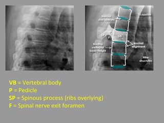 VB = Vertebral body
P = Pedicle
SP = Spinous process (ribs overlying)
F = Spinal nerve exit foramen
 