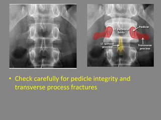 • Check carefully for pedicle integrity and
transverse process fractures
 