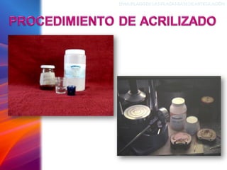 ENMUFLADODELAS PLACAS BASEDEARTICULACIÓN
 