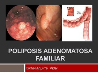 POLIPOSIS ADENOMATOSA
FAMILIAR
Ixchel Aguirre Vidal
 