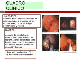 CUADRO
CLÍNICO
MUCORREA:
aumento de la superficie secretora del
colon, dado por la presencia de los
innumerables pólipos de estirpe
adenomatosa y vellosa,
DIARREA:
aumento del peristaltismo,
determinado por el estímulo de
las formaciones polipoideas en la
luz del colon provoca un aumento
del tránsito y disminución de la
absorción de agua.
dolor abdominal de tipo cólico
es debido al hiperperistaltismo
 
