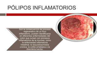 PÓLIPOS INFLAMATORIOS
Son la consecuencia del proceso
regenerativo de un foco
inflamatorio, pueden identificarse
en diferentes enfermedades del
colon que cursan con procesos
inflamatorios de la mucosa, como
la enfermedad inflamatoria
intestinal, la esquistosomiasis
cronica, la colitis amebiana o la
disenteria bacilar.
 