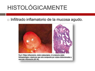 HISTOLÓGICAMENTE
 Infiltrado inflamatorio de la mucosa agudo.
 