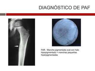 DIAGNÓSTICO DE PAF
FAR. Mancha pigmentada oval con halo
hipopigmentado + manchas pequeñas
hiperpigmentadas
 