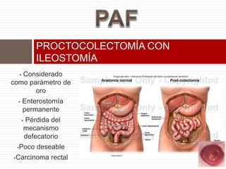  Considerado
como parámetro de
oro
 Enterostomía
permanente
 Pérdida del
mecanismo
defecatorio
Poco deseable
Carcinoma rectal
PROCTOCOLECTOMÍA CON
ILEOSTOMÍA
 