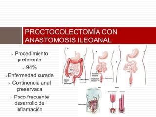  Procedimiento
preferente
 94%
Enfermedad curada
 Continencia anal
preservada
 Poco frecuente
desarrollo de
inflamación
PROCTOCOLECTOMÍA CON
ANASTOMOSIS ILEOANAL
 