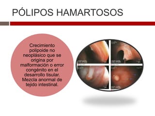 PÓLIPOS HAMARTOSOS
Crecimiento
polipoide no
neoplásico que se
origina por
malformación o error
congénito en el
desarrollo tisular.
Mezcla anormal de
tejido intestinal.
 