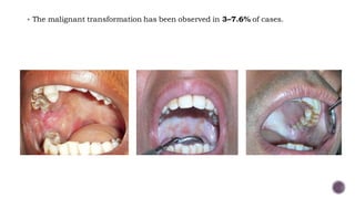 Oral Potentially Malignant Disorders | PDF