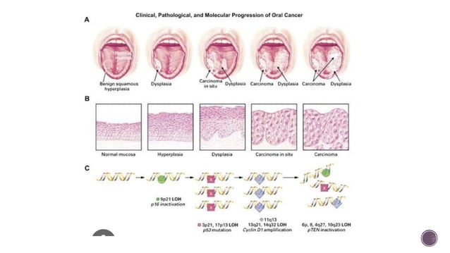 Oral Potentially Malignant Disorders | PDF | Skin and Dermatology ...