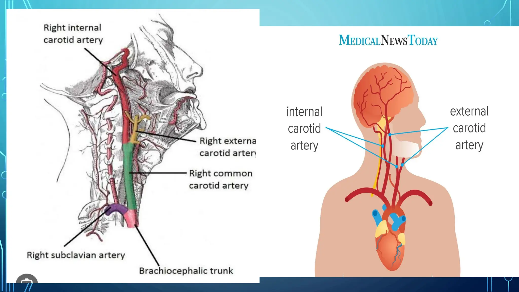 CECT NECK NECK ANGIOGRAPHY CAROTID ANGIOGRAPHY | PDF