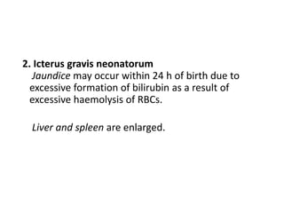 2. Icterus gravis neonatorum
Jaundice may occur within 24 h of birth due to
excessive formation of bilirubin as a result of
excessive haemolysis of RBCs.
Liver and spleen are enlarged.
 
