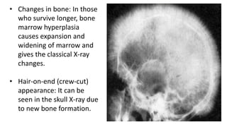 • Changes in bone: In those
who survive longer, bone
marrow hyperplasia
causes expansion and
widening of marrow and
gives the classical X-ray
changes.
• Hair-on-end (crew-cut)
appearance: It can be
seen in the skull X-ray due
to new bone formation.
 