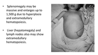 • Splenomegaly may be
massive and enlarges up to
1,500 g due to hyperplasia
and extramedullary
hematopoiesis.
• Liver (hepatomegaly) and
lymph nodes also may show
extramedullary
hematopoiesis.
 