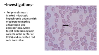 •Investigations-
• Peripheral smear :
Marked microcytic
hypochromic anemia with
moderate to marked
anisocytosis and
poikilocytosis. Many
target cells (hemoglobin
collects in the center of
RBCs) and nucleated red
cells are visible.
 