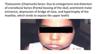 Thalassemic (Chipmunk) facies: Due to enlargement and distortion
of craniofacial bones (frontal bossing of the skull, prominent malar
eminence, depression of bridge of nose, and hypertrophy of the
maxillae, which tends to expose the upper teeth)
 
