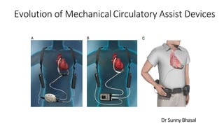 Evolution of Mechanical Circulatory Assist Devices
Dr Sunny Bhasal
 