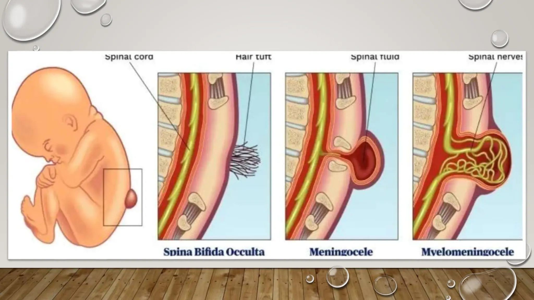 Netural Defect Neural tube defect | PPTX