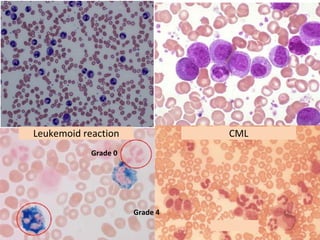 Blood smear Examination for different pathology | PDF