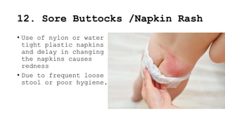 Napkin Rash Minor disorder of newborn child health nuring | PPTX
