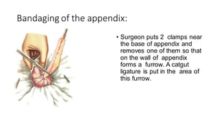 APPENDECTOMY PRESENTATION BY GENERAL SURGERY | PDF
