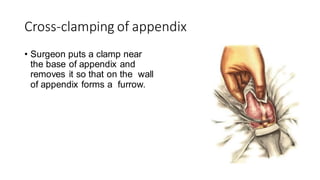 APPENDECTOMY PRESENTATION BY GENERAL SURGERY | PDF