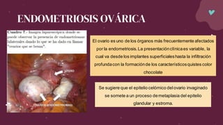 ENDOMETRIOSIS OVÁRICA
El ovario es uno de los órganos más frecuentemente afectados
por la endometriosis.La presentaciónclínicaes variable, la
cual va desde los implantes superficialeshasta la infiltración
profundacon la formaciónde los característicosquistes color
chocolate
Se sugiere que el epitelio celómico delovario invaginado
se somete a un proceso demetaplasia del epitelio
glandular y estroma.
 