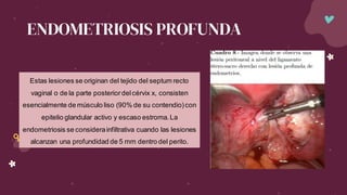 ENDOMETRIOSIS PROFUNDA
Estas lesiones se originan del tejido del septum recto
vaginal o de la parte posteriordelcérvix x, consisten
esencialmente de músculo liso (90% de su contendio)con
epitelio glandular activo y escaso estroma.La
endometriosis se considerainfiltrativa cuando las lesiones
alcanzan una profundidad de 5 mm dentro del perito.
 