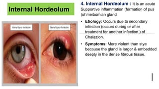eyelid-deformities-by-rutuja-mane-bsc-nursing-pptx