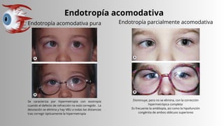 Endotropía acomodativa
Se caracteriza por hipermetropía con esotropía
cuando el defecto de refracción no está corregido . La
desviación se elimina y hay VBU a todas las distancias
tras corregir ópticamente la hipermetropía
Endotropía acomodativa pura
Disminuye, pero no se elimina, con la corrección
hipermetrópica completa
Es frecuente la ambliopía, así como la hipofunción
congénita de ambos oblicuos superiores
Endotropía parcialmente acomodativa
 