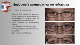 Endotropía acomodativa no refractiva
Exceso de convergencia
Cociente CA/A elevado por aumento
de la convergencia acomodativa (la
acomodación es normal, pero la
convergencia está aumentada).
Punto próximo de acomodación
normal.
Ojos alineados con VBU para lejos.
Esotropía de cerca, normalmente con
supresión
Ojos derechos con bifocales
 