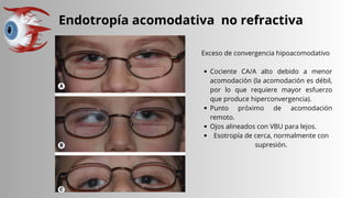 Endotropía acomodativa no refractiva
Exceso de convergencia hipoacomodativo
Cociente CA/A alto debido a menor
acomodación (la acomodación es débil,
por lo que requiere mayor esfuerzo
que produce hiperconvergencia).
Punto próximo de acomodación
remoto.
Ojos alineados con VBU para lejos.
Esotropía de cerca, normalmente con
supresión.
 