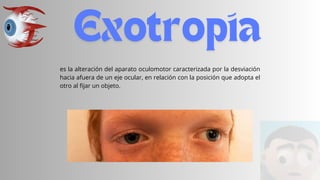 es la alteración del aparato oculomotor caracterizada por la desviación
hacia afuera de un eje ocular, en relación con la posición que adopta el
otro al fijar un objeto.
 