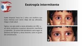 Exotropía intermitente
Suele empezar hacia los 2 años con exoforia que
luces intensas (con cierre relejo del ojo afectado),
fatiga o mala salud.
Signos. Los ojos están a veces alineados con VBU , y
en otros momentos muestran desviación manifiesta
y supresión . El control del estrabismo varía según la
distancia de fijación y otros factores, como el grado
de concentración.
 