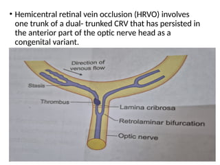 • Hemicentral retinal vein occlusion (HRVO) involves
one trunk of a dual- trunked CRV that has persisted in
the anterior part of the optic nerve head as a
congenital variant.
 