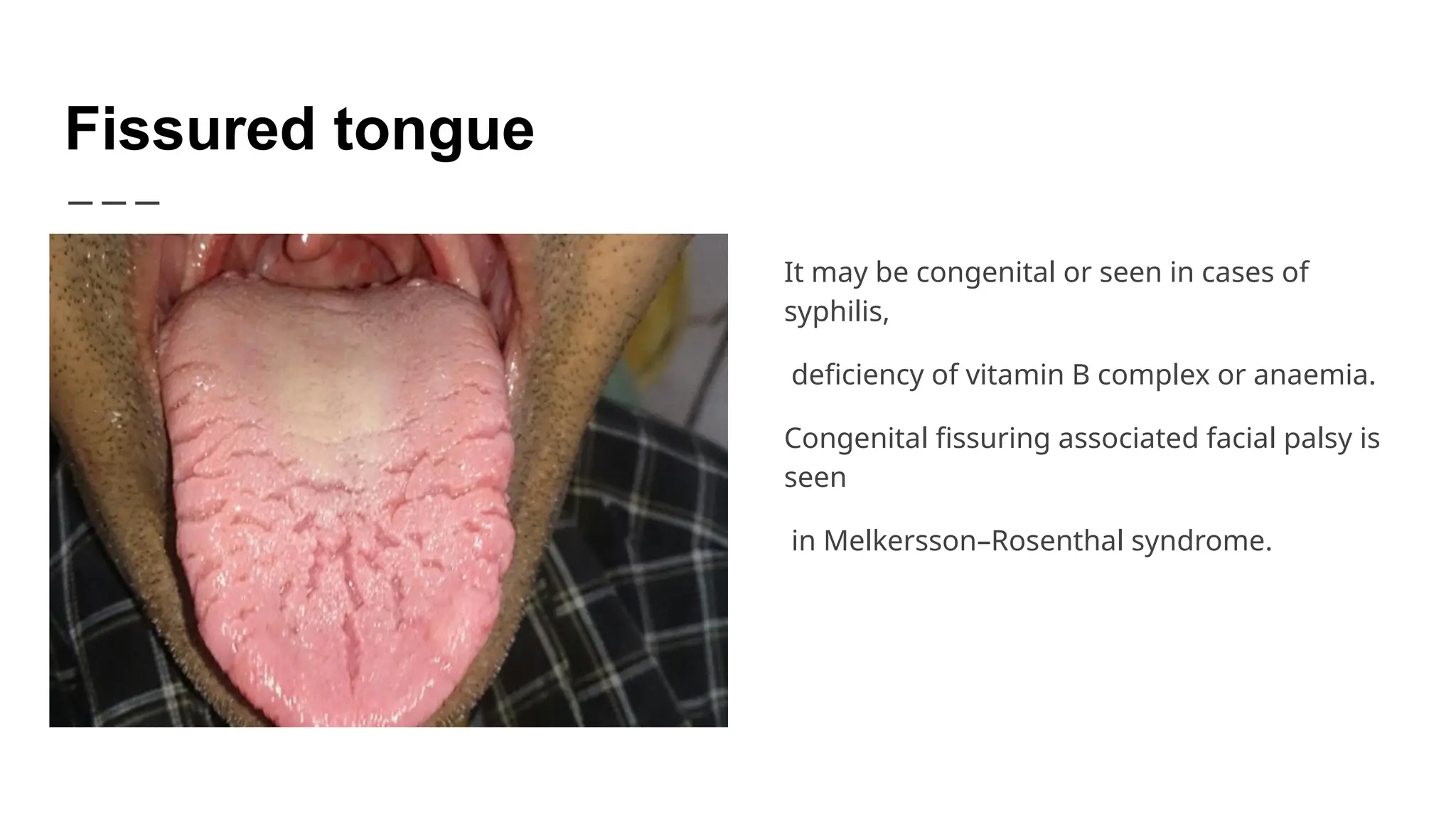 Miscellaneous lesions of oral cavity and tongue | PPTX
