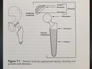 Total hip replacement and types of prosthesis | PPTX