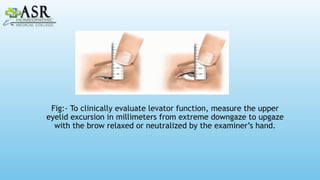 UNDERSTANDING PTOSIS:CAUSES,CLASSIFICATION, DIAGNOSIS, AND TREATMENT.pptx