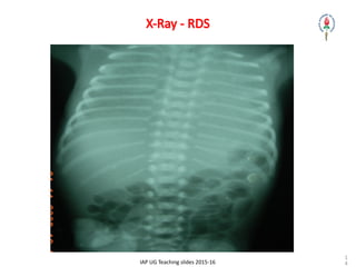 Respiratory distress syndrome in newborn | PPT