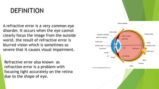 Power point presentation on REFRACTIVE ERRORS | PDF