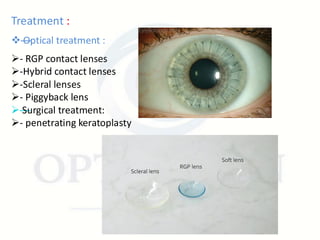 Piggyback Rgp Astigmatism – Types, Causes, and Management | PDF