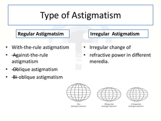 Astigmatism – Types, Causes, and Management | PDF
