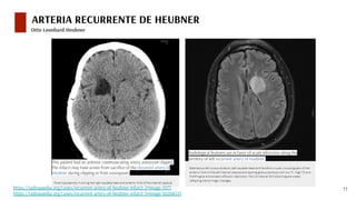 Revisión de tema: epónimos es neurocirugía vascular | PDF