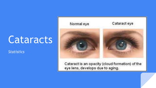 Cataracts
Statistics
 