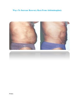 Ways To Increase Recovery Rate From Abdominoplasty




Fitness
 