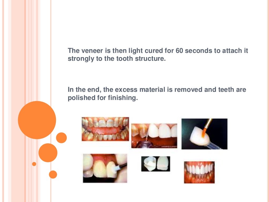 The process of placing dental veneers