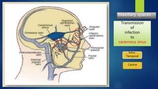 Transmission
of
infection
to
cavernous sinus
Maxillary spaces
Infra-
Temporal
Canine
 